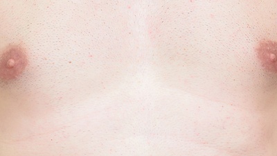 Chest After Laser Hair Removal