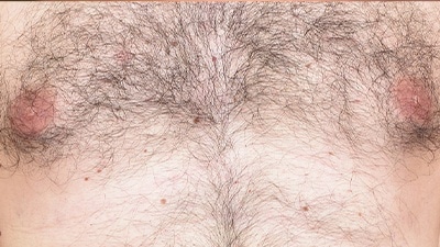 Chest Before Laser Hair Removal