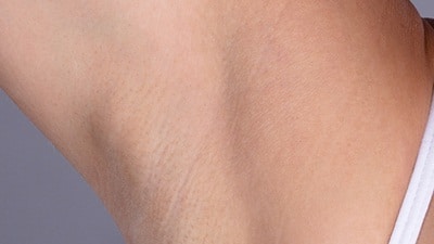Armpit After EpiLaze Hair Removal