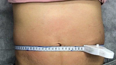 Waist Measurement After BodySculp Treatment