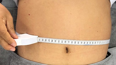 Waist Measurement Before BodySculp Fat Reduction