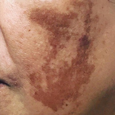 Skin Blemish Removal with PicoLazer - Before