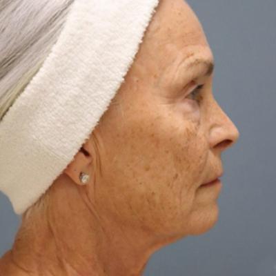 Face After PiXel8-RF Microneedling Treatment