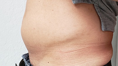 Before BodySculp Non-Surgical Fat Reduction on Tummy