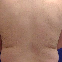 After 810-Diode Back Hair Removal with Spectrum