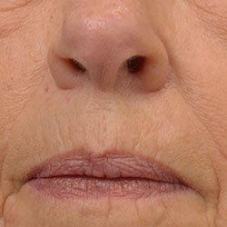 Nose and Mouth IPL Treatment with Spectrum - After
