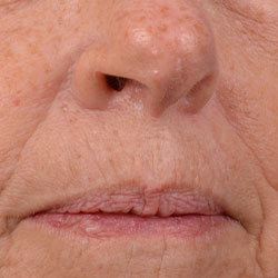 Nose and Mouth IPL Treatment with Spectrum - Before