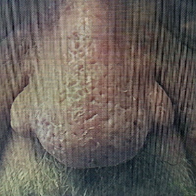 Nose with Smaller Pores After Phoenix CO2 Laser Treatment