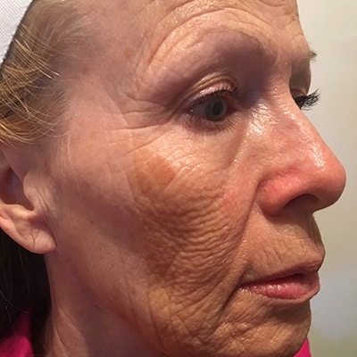 Before Facial Wrinkle Reduction with the Phoenix CO2 Laser