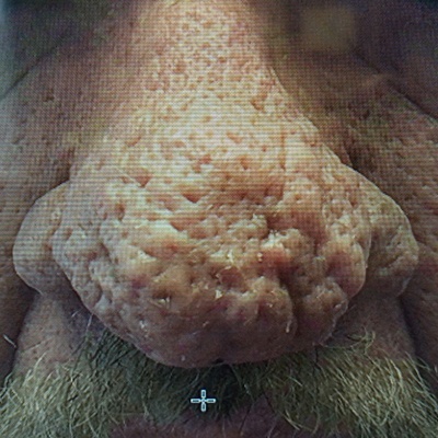 Nose with Large Pores Before Phoenix CO2 Laser Treatment