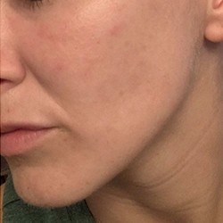 After Spectrum Intense Pulsed Light Acne Treament