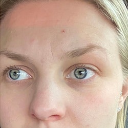 Woman's Face after IPL Treatment