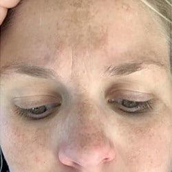 Face Before IPL Treatment