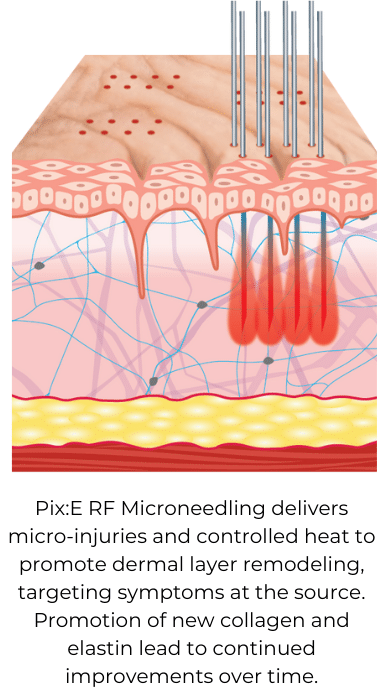 Graphic Illustration of Pix:E RF Microneedling Process: Micro-Injuries and Controlled Heat for Dermal Remodeling, Stimulating New Collagen and Elastin Production for Long-Term Skin Enhancement.